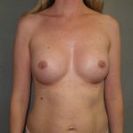 Breast Augmentation Before & After Patient #2531