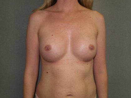 Breast Augmentation Before & After Patient #2531