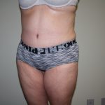 Tummy Tuck Before & After Patient #1832