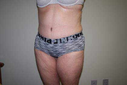 Tummy Tuck Before & After Patient #1832