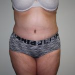 Tummy Tuck Before & After Patient #1832