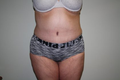 Tummy Tuck Before & After Patient #1832