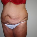 Tummy Tuck Before & After Patient #1832
