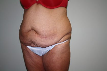 Tummy Tuck Before & After Patient #1832