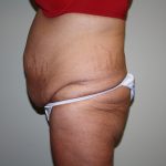 Tummy Tuck Before & After Patient #1832