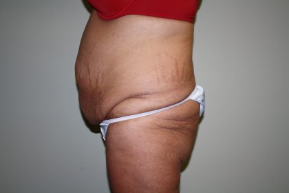 Tummy Tuck Before & After Patient #1832