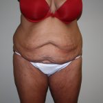 Tummy Tuck Before & After Patient #1832