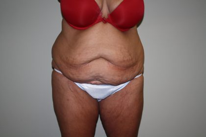 Tummy Tuck Before & After Patient #1832