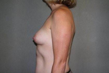 Breast Augmentation Before & After Patient #2584