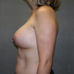 Breast Augmentation Before & After Patient #2584