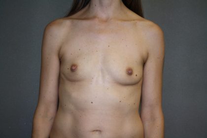Breast Augmentation Before & After Patient #2598