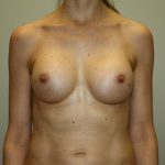 Breast Augmentation Before & After Patient #2598