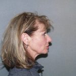 Facelift Before & After Patient #585