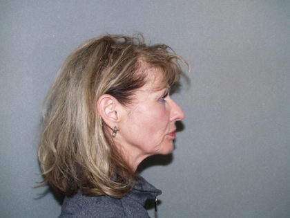 Facelift Before & After Patient #585
