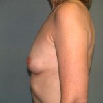 Breast Augmentation Before & After Patient #2871