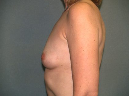 Breast Augmentation Before & After Patient #2871