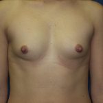 Breast Augmentation Before & After Patient #2941