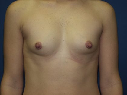 Breast Augmentation Before & After Patient #2941