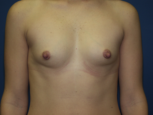 Breast Augmentation Before & After Patient #2941
