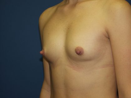 Breast Augmentation Before & After Patient #2941