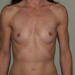 Breast Augmentation Before & After Patient #2990