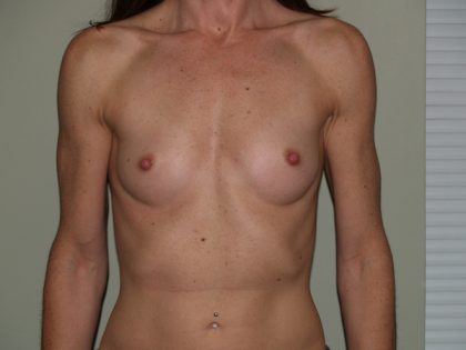 Breast Augmentation Before & After Patient #2990
