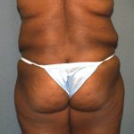 Brazilian Butt Lift Before & After Patient #438