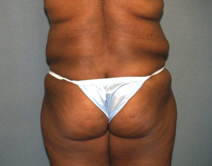 Brazilian Butt Lift Before & After Patient #438