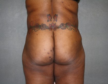 Brazilian Butt Lift Before & After Patient #438