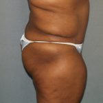 Brazilian Butt Lift Before & After Patient #438