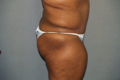 Brazilian Butt Lift Before & After Patient #438