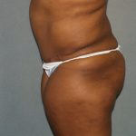 Brazilian Butt Lift Before & After Patient #438