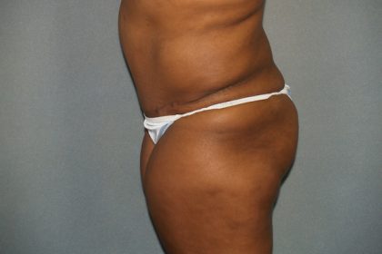 Brazilian Butt Lift Before & After Patient #438