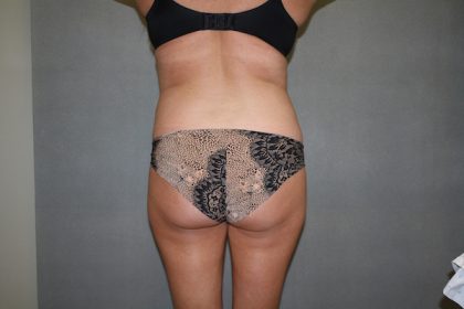 Brazilian Butt Lift Before & After Patient #461