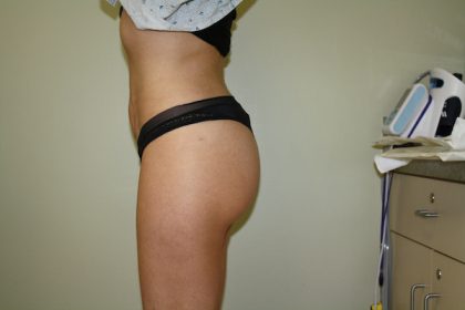 Brazilian Butt Lift Before & After Patient #461