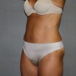 Tummy Tuck Before & After Patient #2194