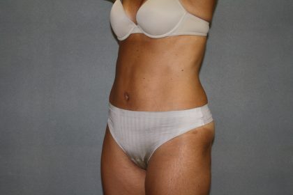 Tummy Tuck Before & After Patient #2194