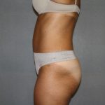 Tummy Tuck Before & After Patient #2194