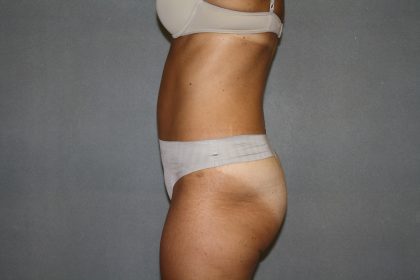 Tummy Tuck Before & After Patient #2194