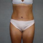 Tummy Tuck Before & After Patient #2194