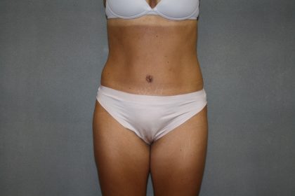 Tummy Tuck Before & After Patient #2194