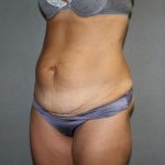 Tummy Tuck Before & After Patient #2194