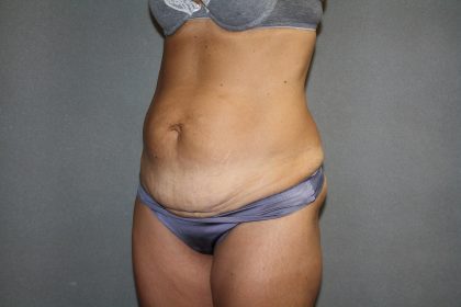 Tummy Tuck Before & After Patient #2194