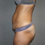 Tummy Tuck Before & After Patient #2194