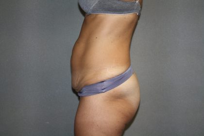 Tummy Tuck Before & After Patient #2194