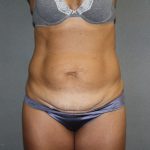 Tummy Tuck Before & After Patient #2194
