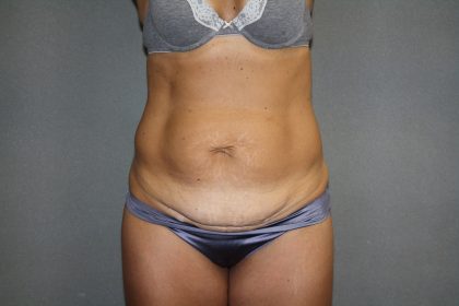 Tummy Tuck Before & After Patient #2194