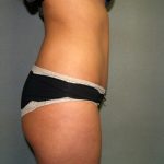 Tummy Tuck Before & After Patient #1875
