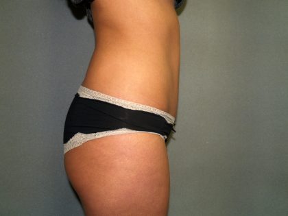 Tummy Tuck Before & After Patient #1875
