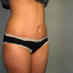 Tummy Tuck Before & After Patient #1875